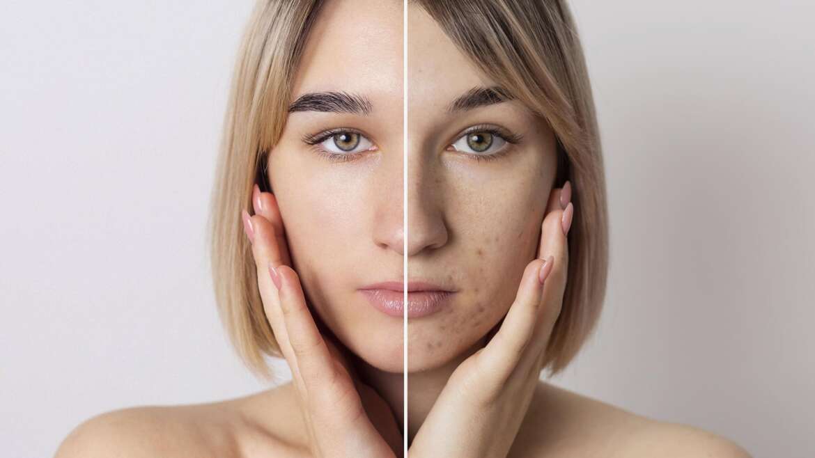 Melasma