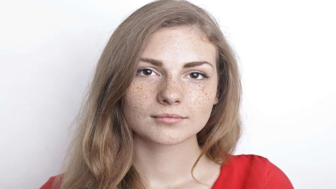 Age Spots & Freckles