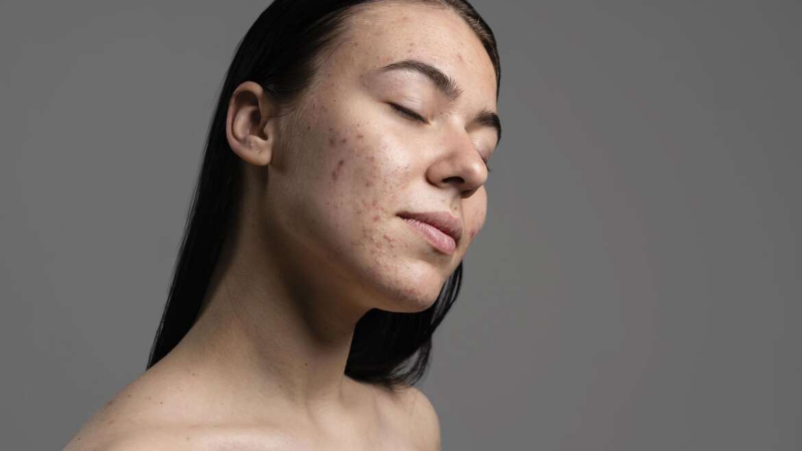 Acne Scarring