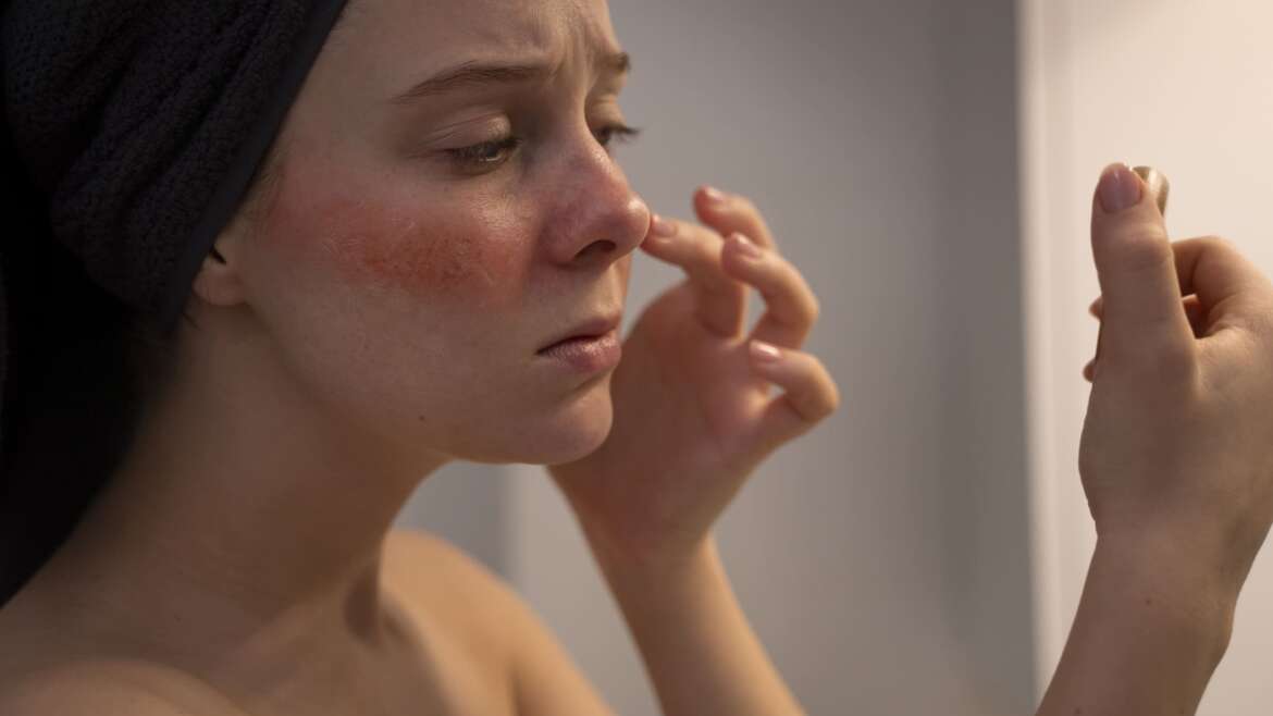 Post Inflammatory Hyperpigmentation