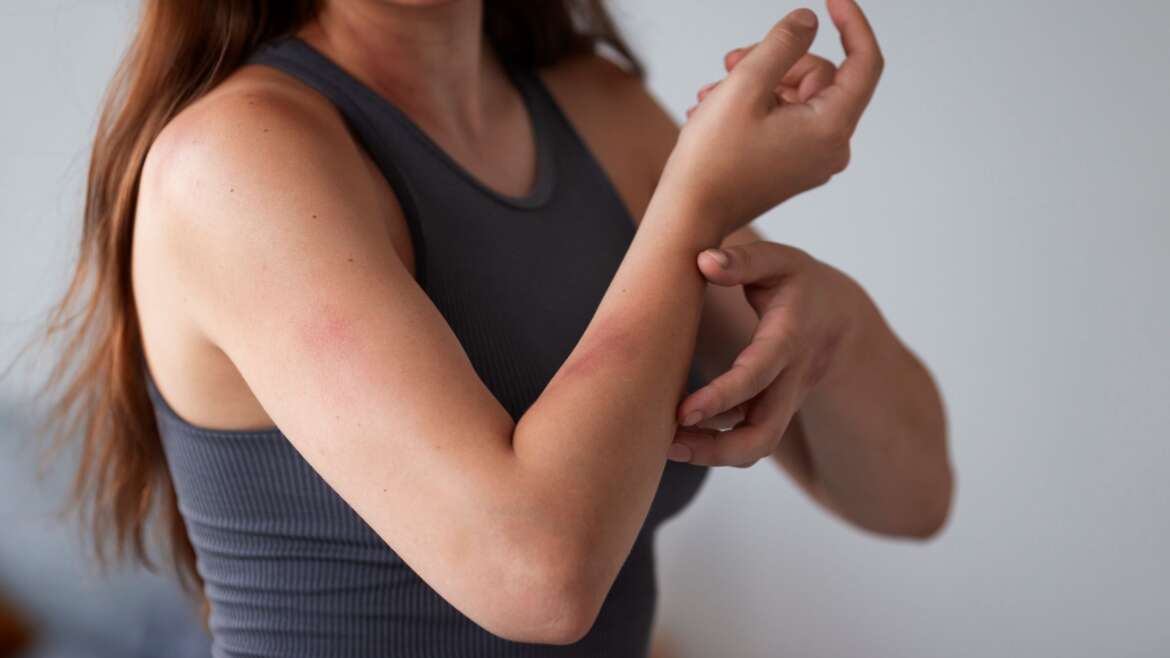 Dermatitis