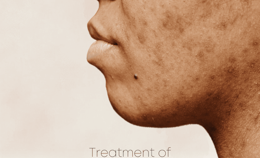 Brightening / Pigmentation