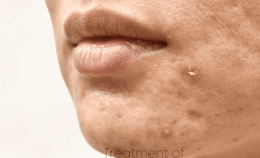 Acne Laser Therapy (Clear Skin Pro)