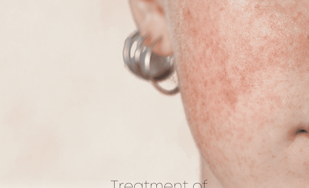 Facial Redness Laser Therapy